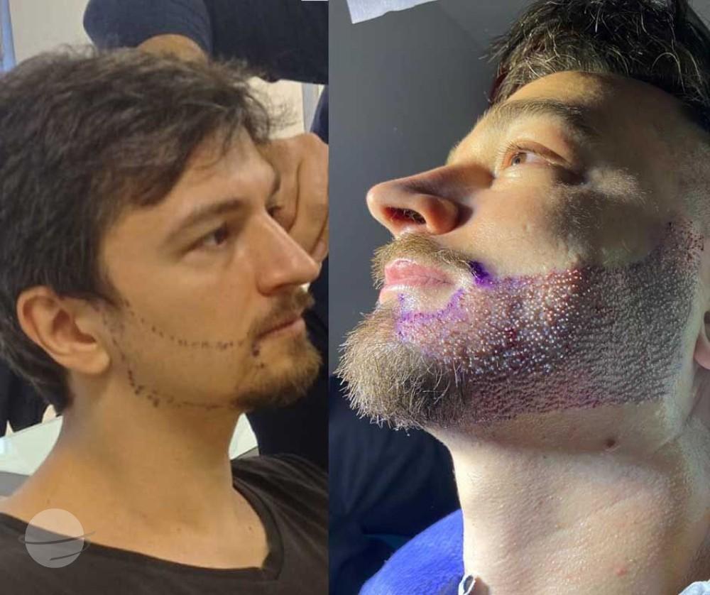 Beard Transplant by Esthetic Planet Team