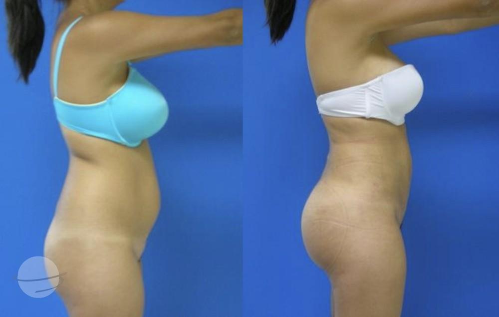 Results BBL by Dr Miklos Molnar