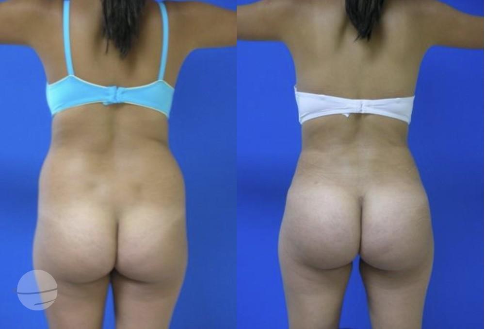 Results BBL by Dr Miklos Molnar