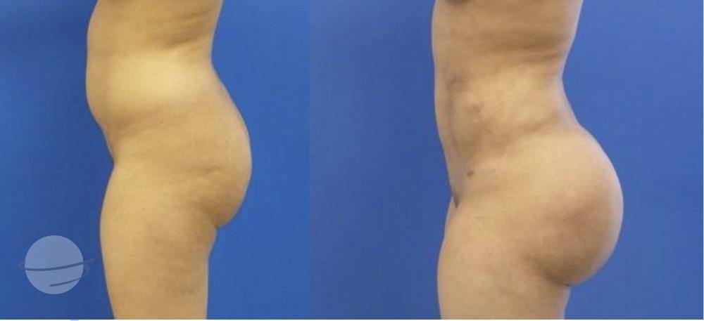 Results BBL by Dr Miklos Molnar