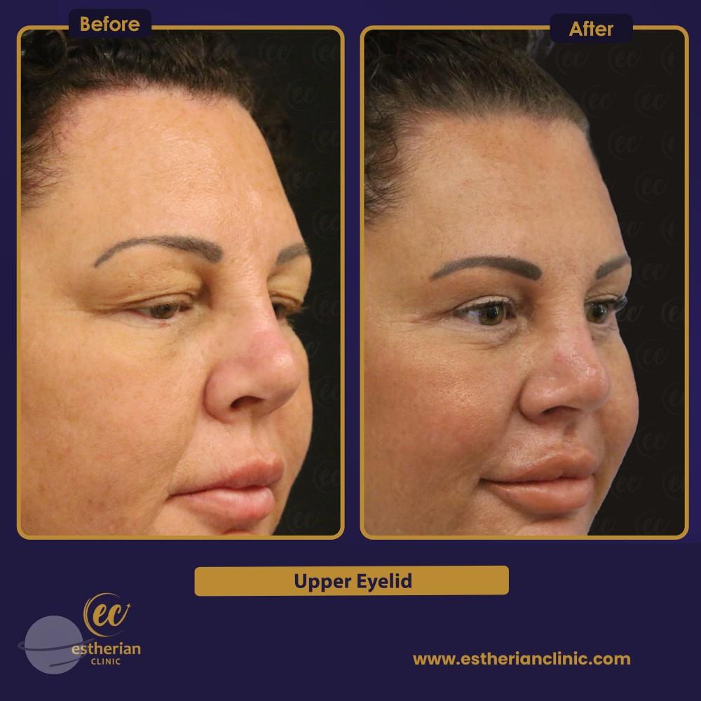 Blepharoplastie UPPER EYELID Turkey 3