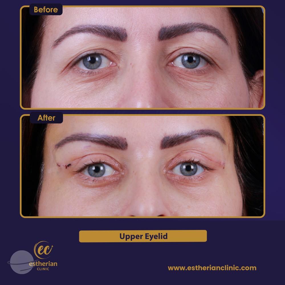 Blepharoplastie UPPER EYELID Turkey 1