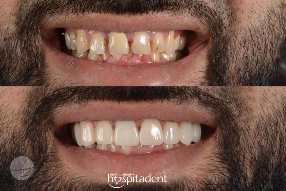 Dental Zirconium crown9