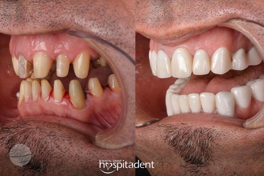 Dental Zirconium crown10