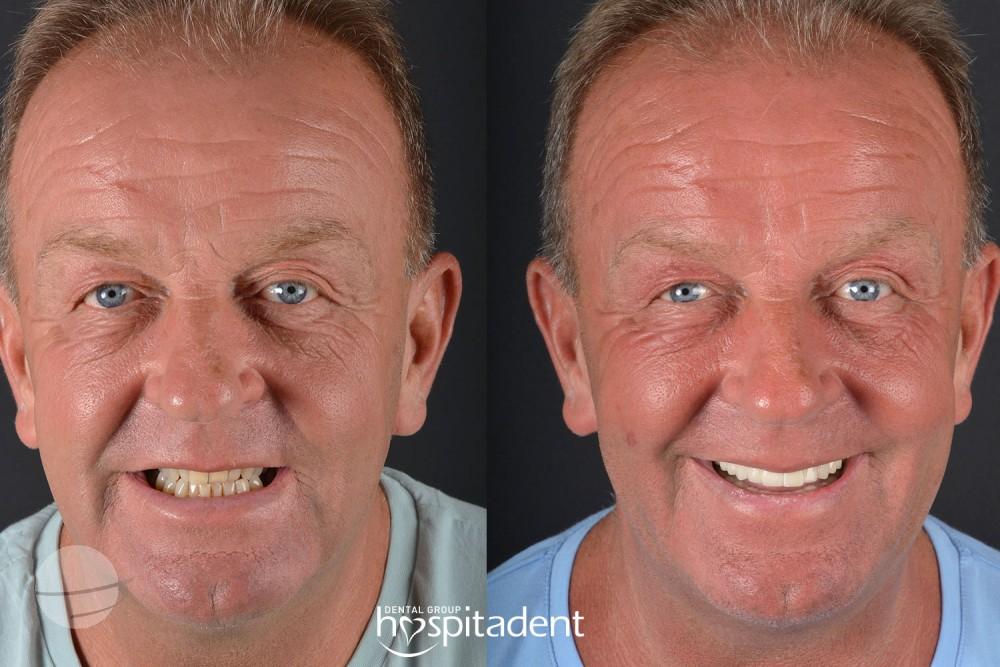 Dental Zirconium crown6