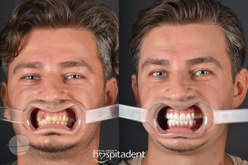 Dental Zirconium crown3