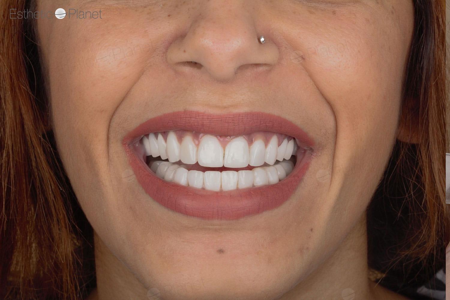 Veneers by Dentaglobal