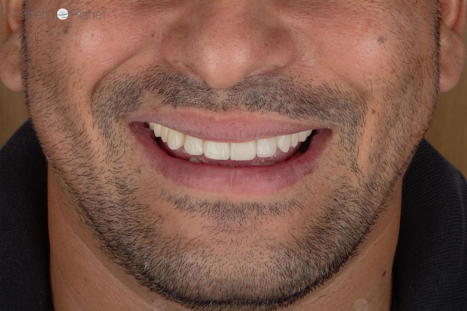 Veneers by Dentaglobal