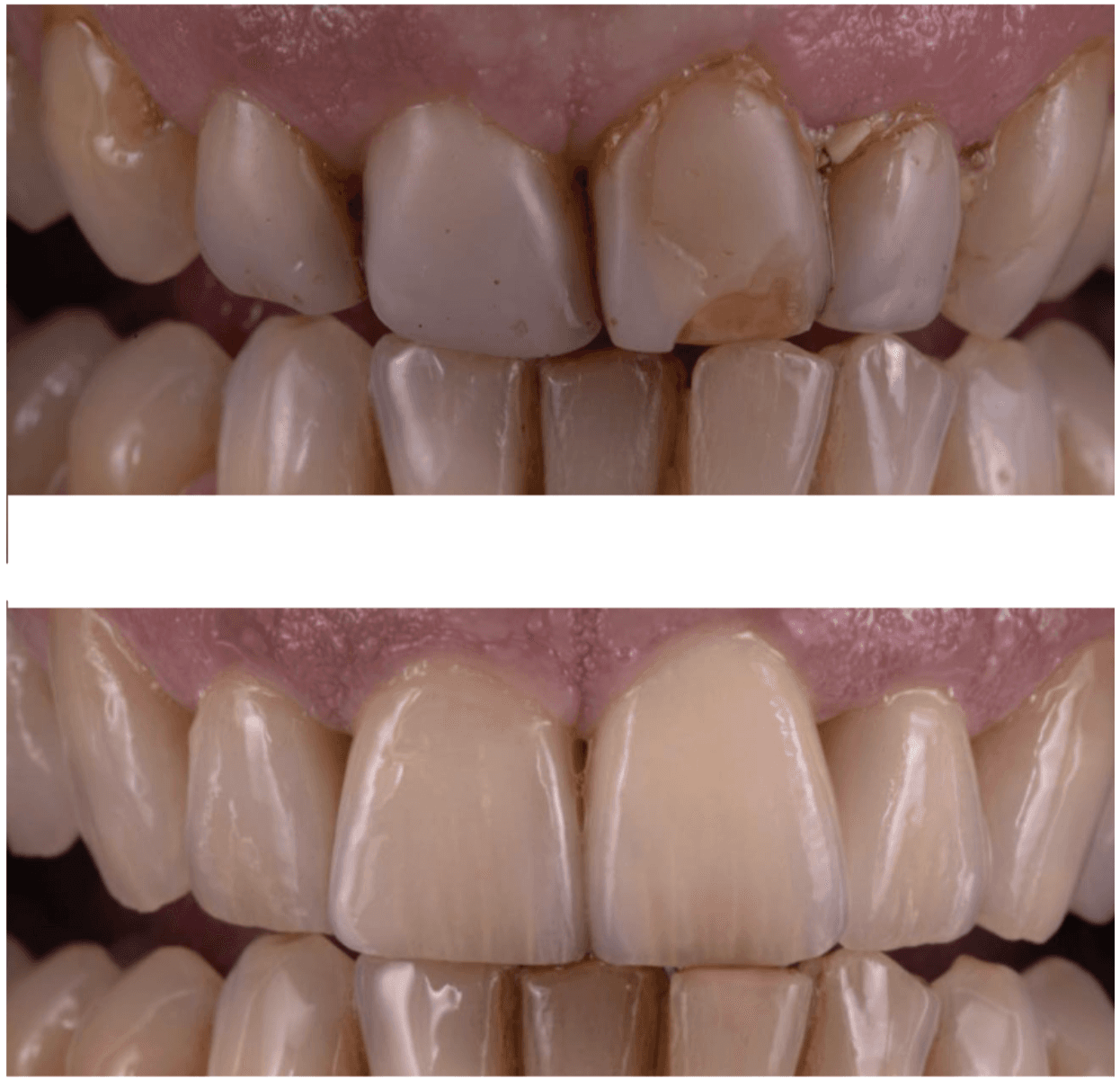 8-couronnes-céramiques
