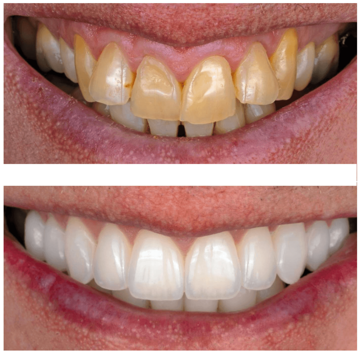 10-couronnes-céramiques