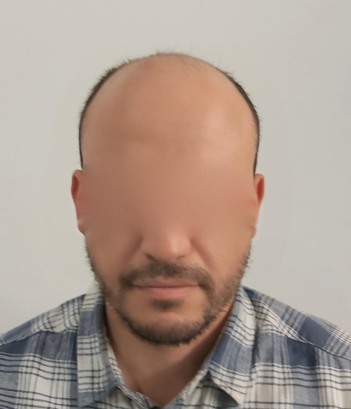 Dr Sofiene Ouerghi before : after