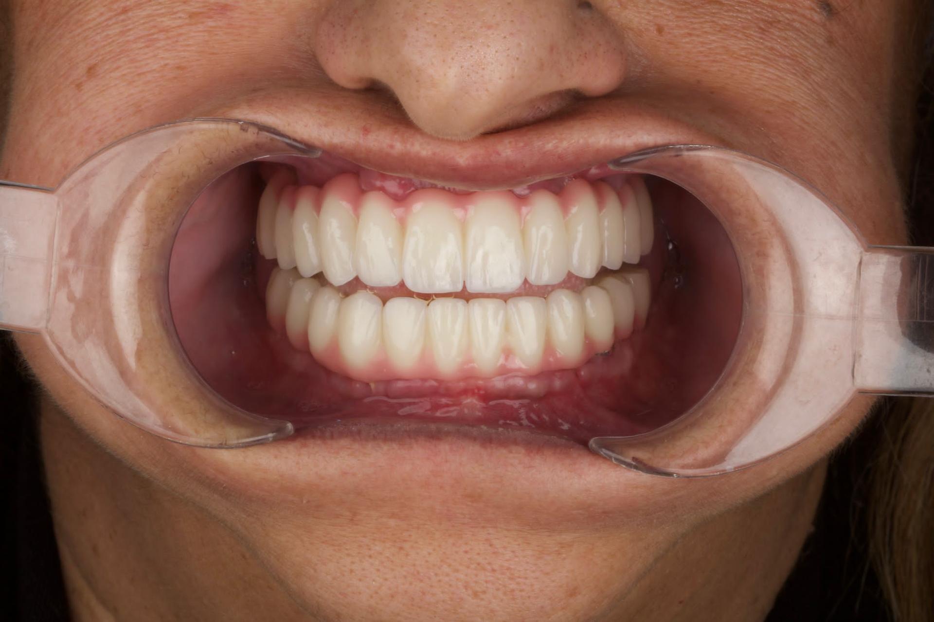 Crowns by Dentaglobal