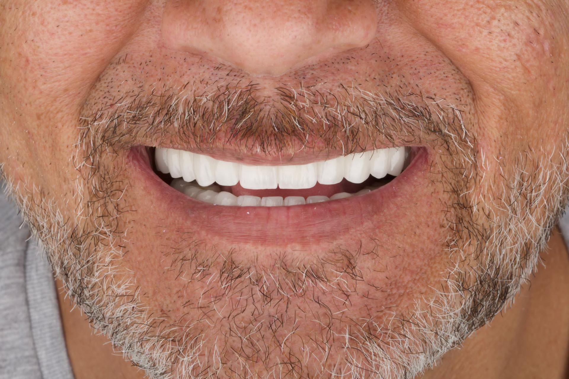 Crowns by Dentaglobal