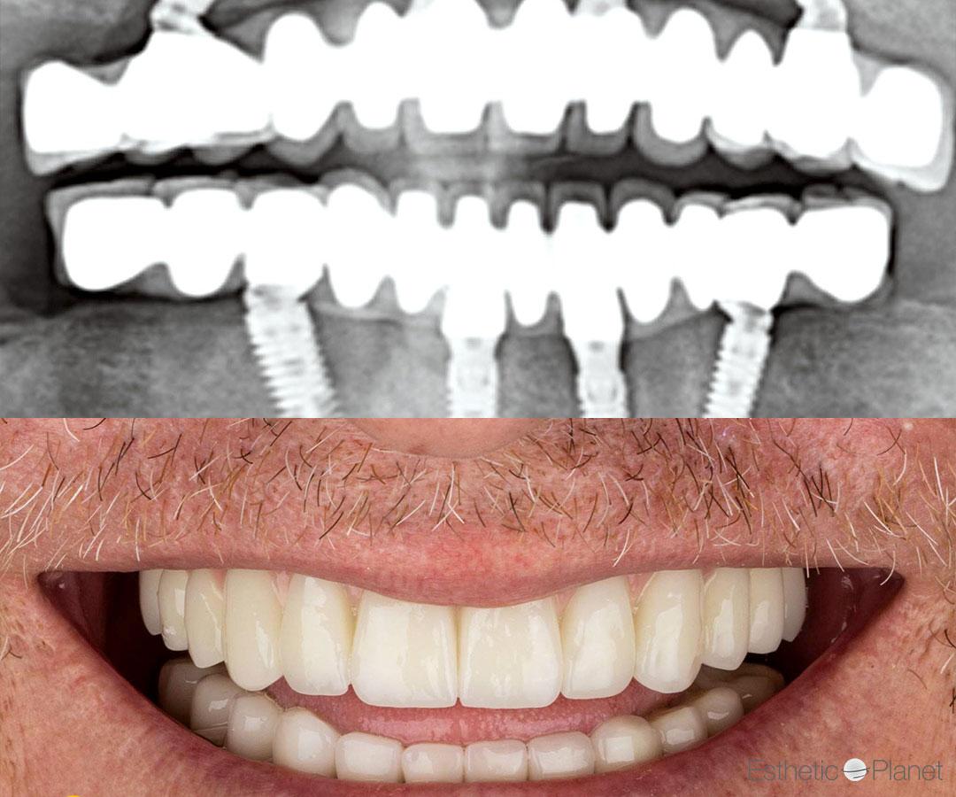 Crowns by Dentaglobal