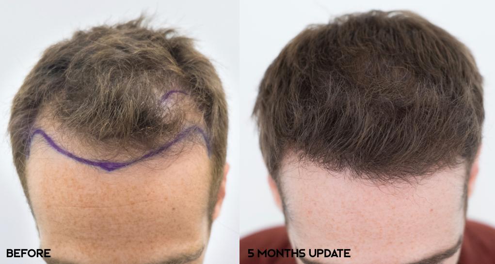 Dr Bruno Ferreira FUE