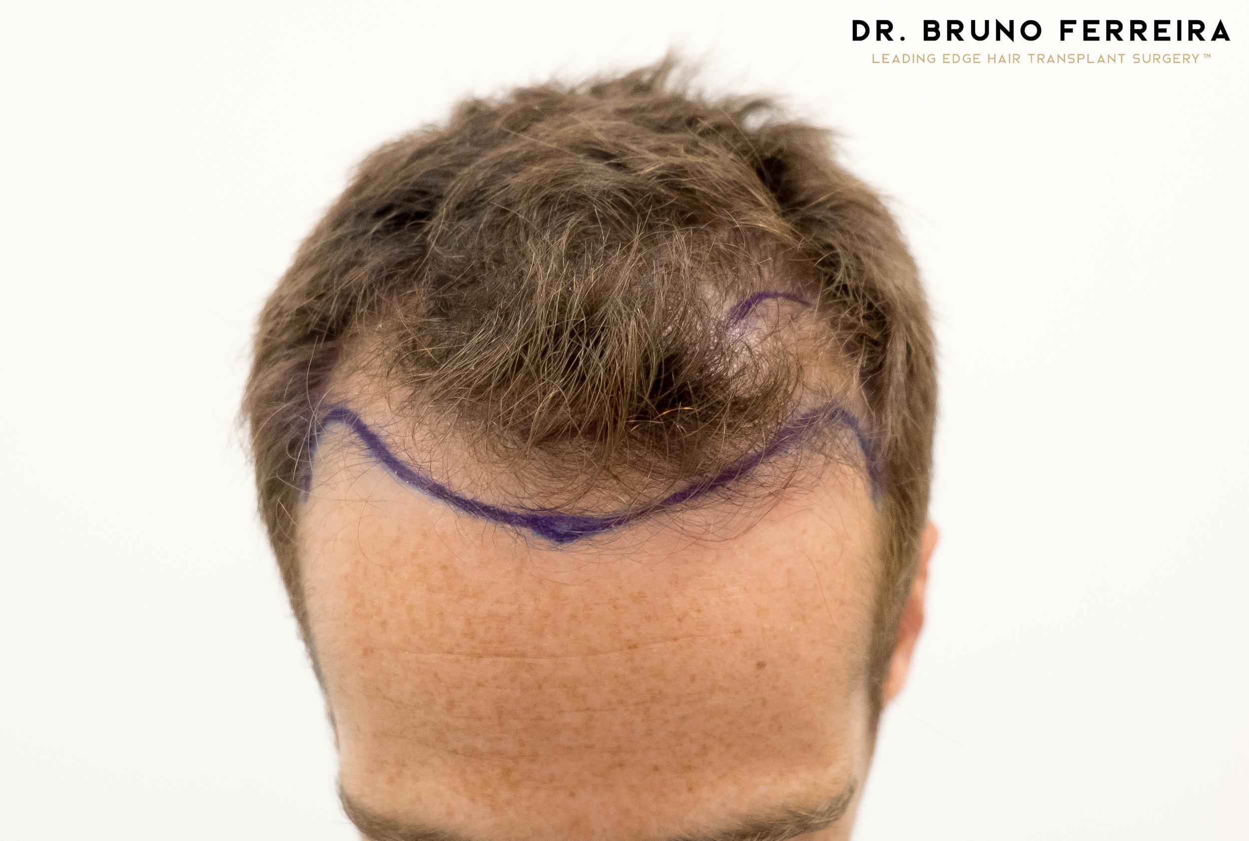 Dr Bruno Ferreira FUE before