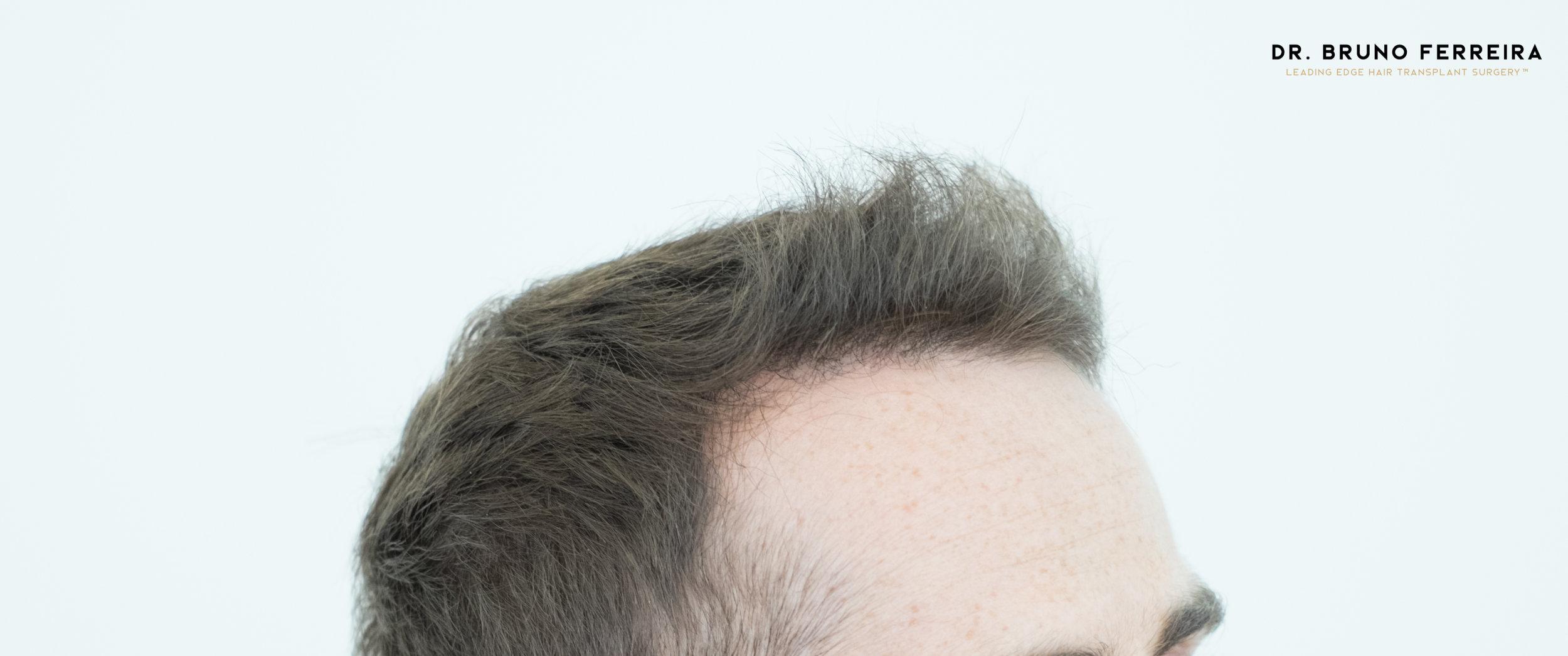 Dr Bruno Ferreira FUE 5 months after