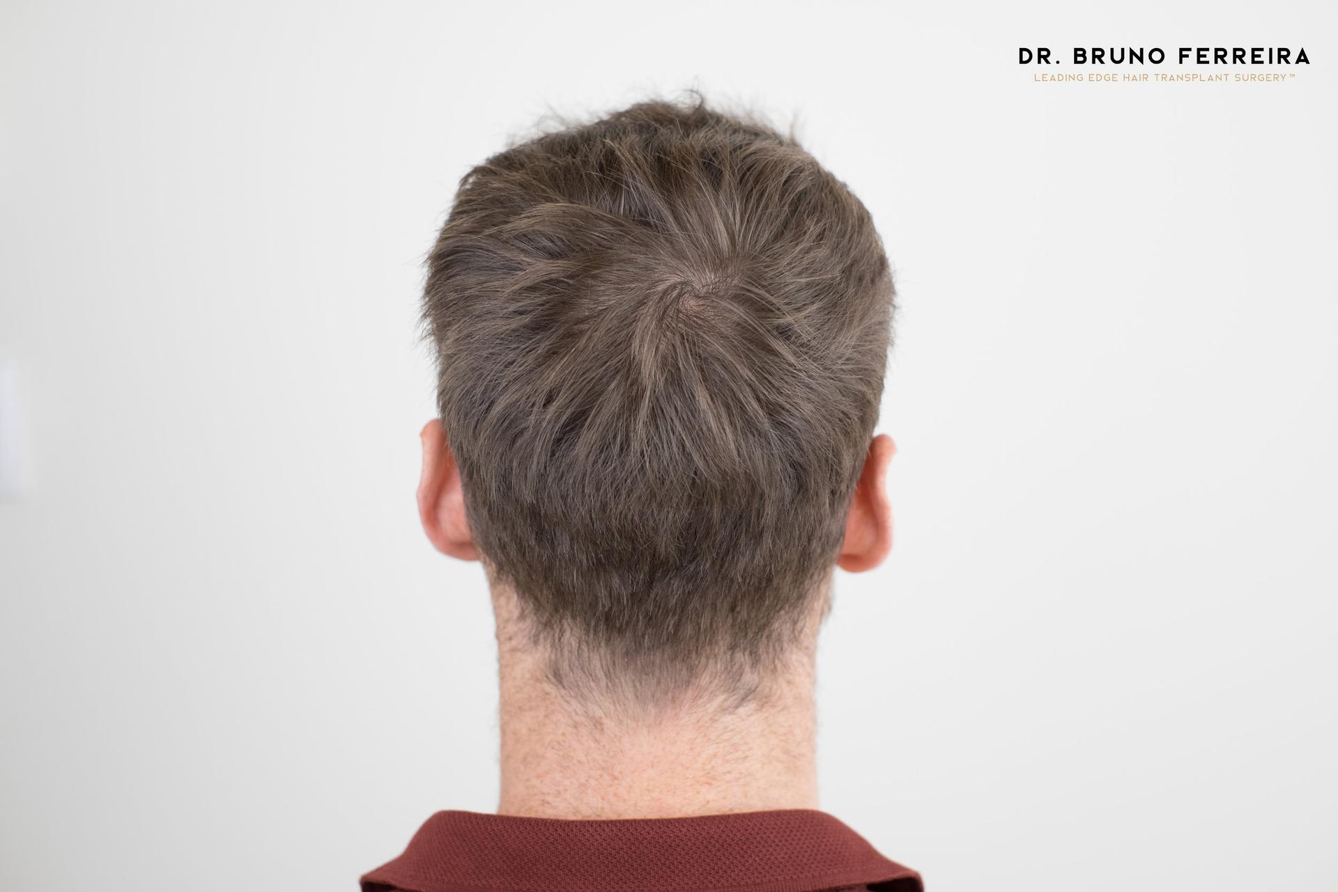Dr Bruno Ferreira FUE donor area before