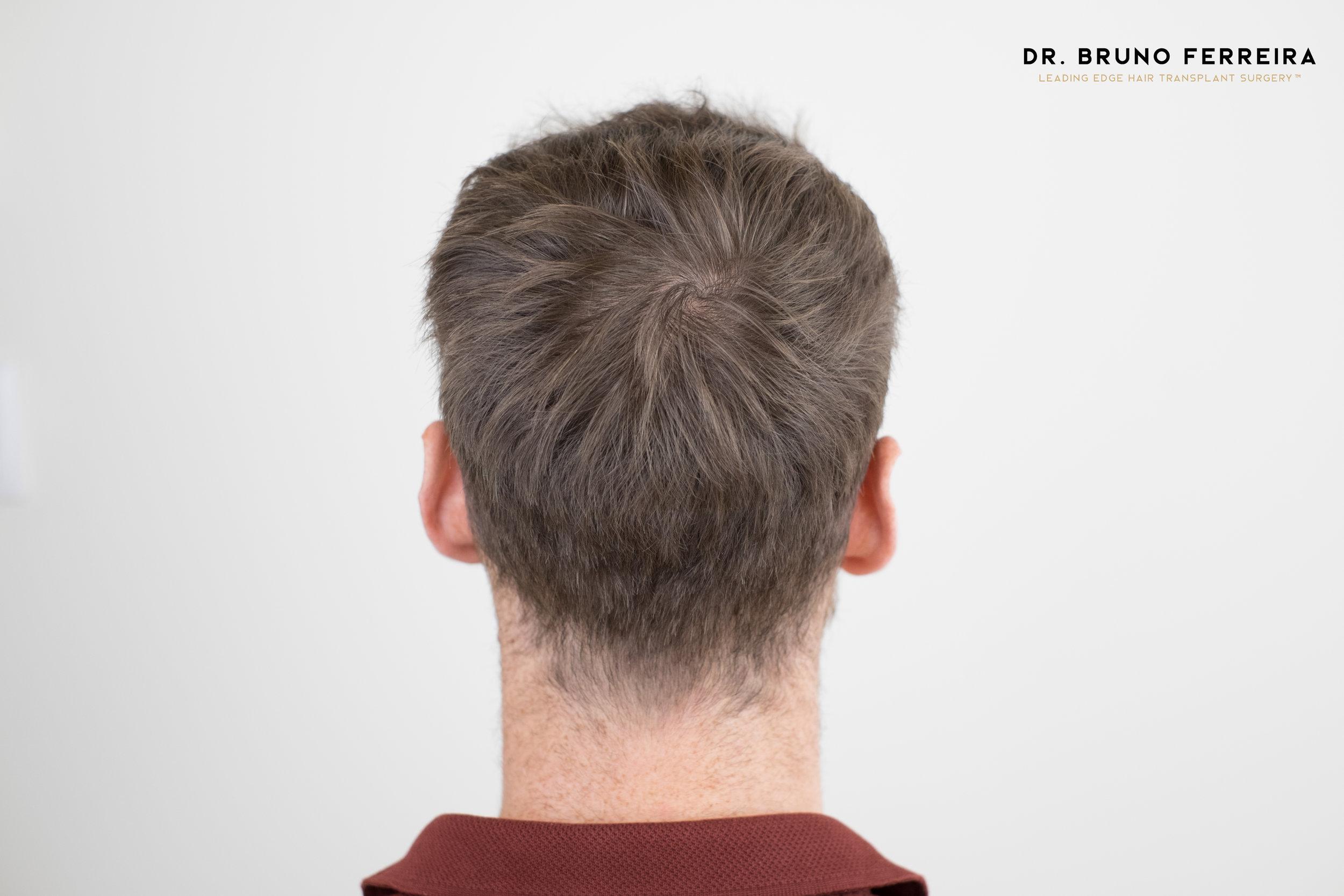 Dr Bruno Ferreira FUE donor area before