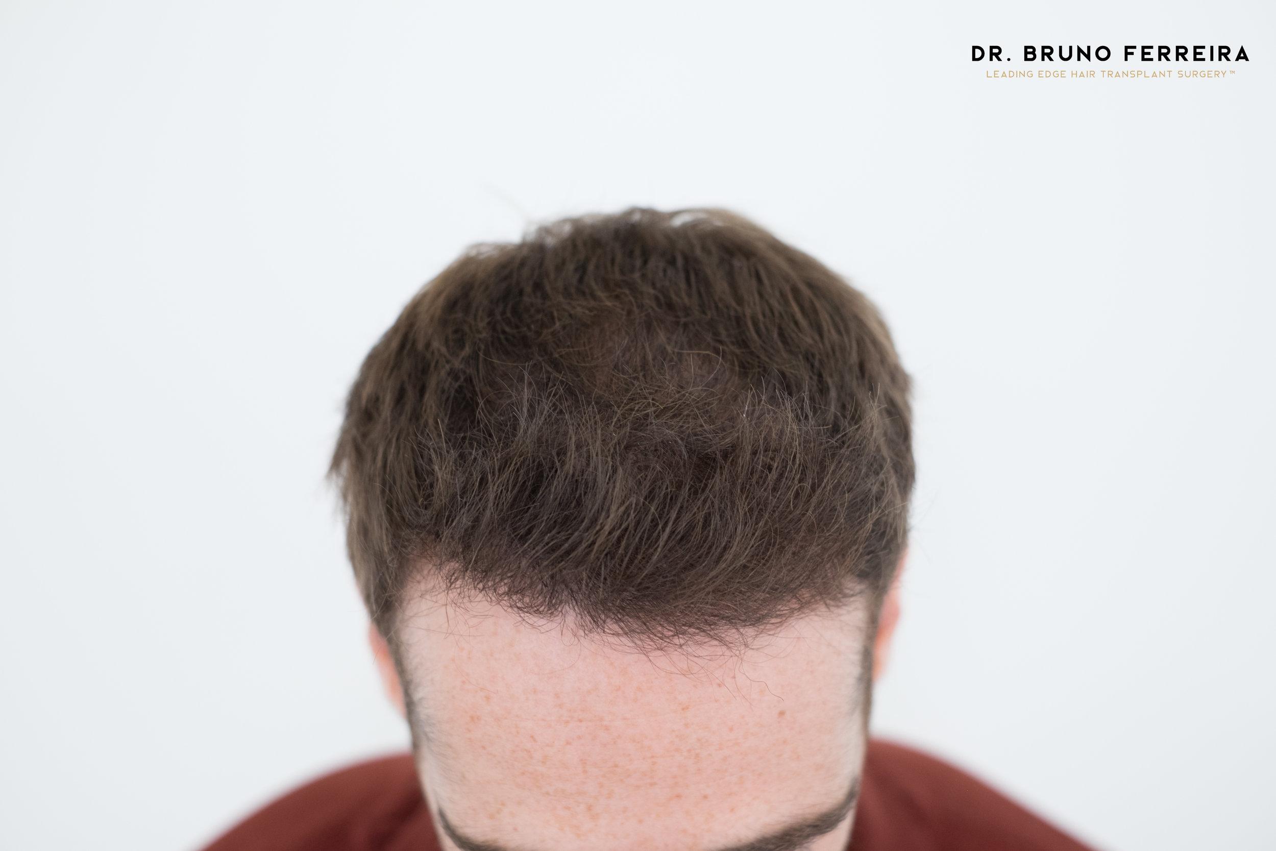 Dr Bruno Ferreira FUE 5 months after