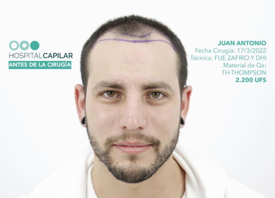 hospital capillar before hair transplant