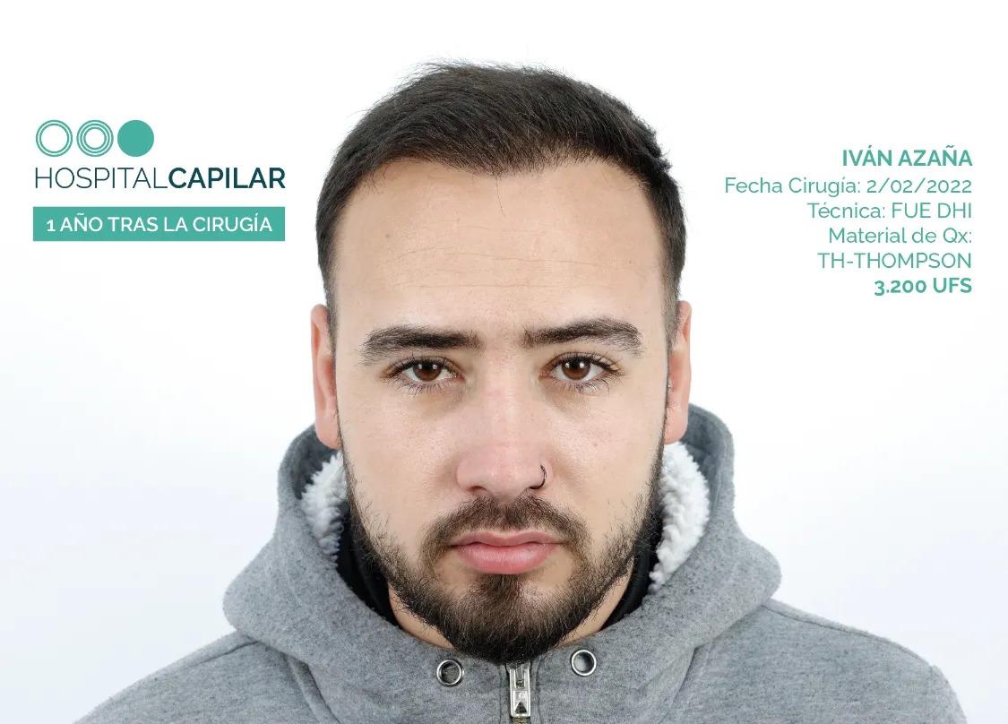hospital capillar results hair transplant