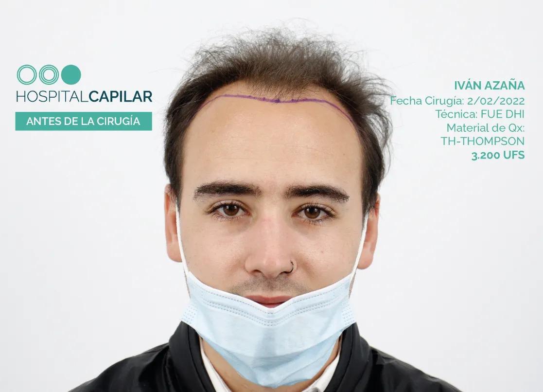 hospital capillar before hair transplant