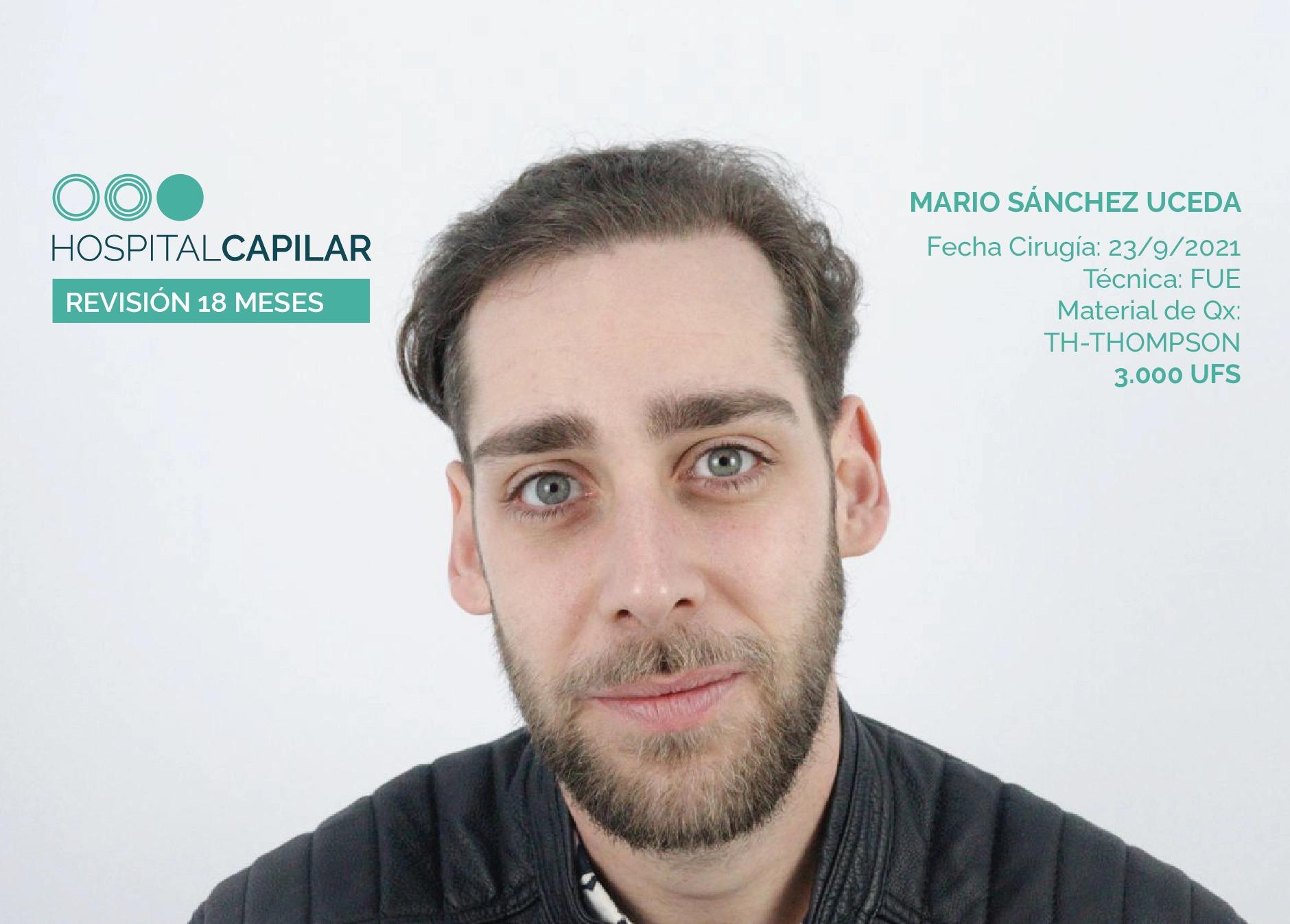 hospital-capillar-before-and-aftersMARIO_18M-copia