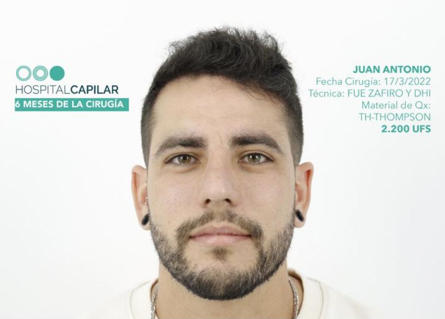 hospital capillar results hair transplant