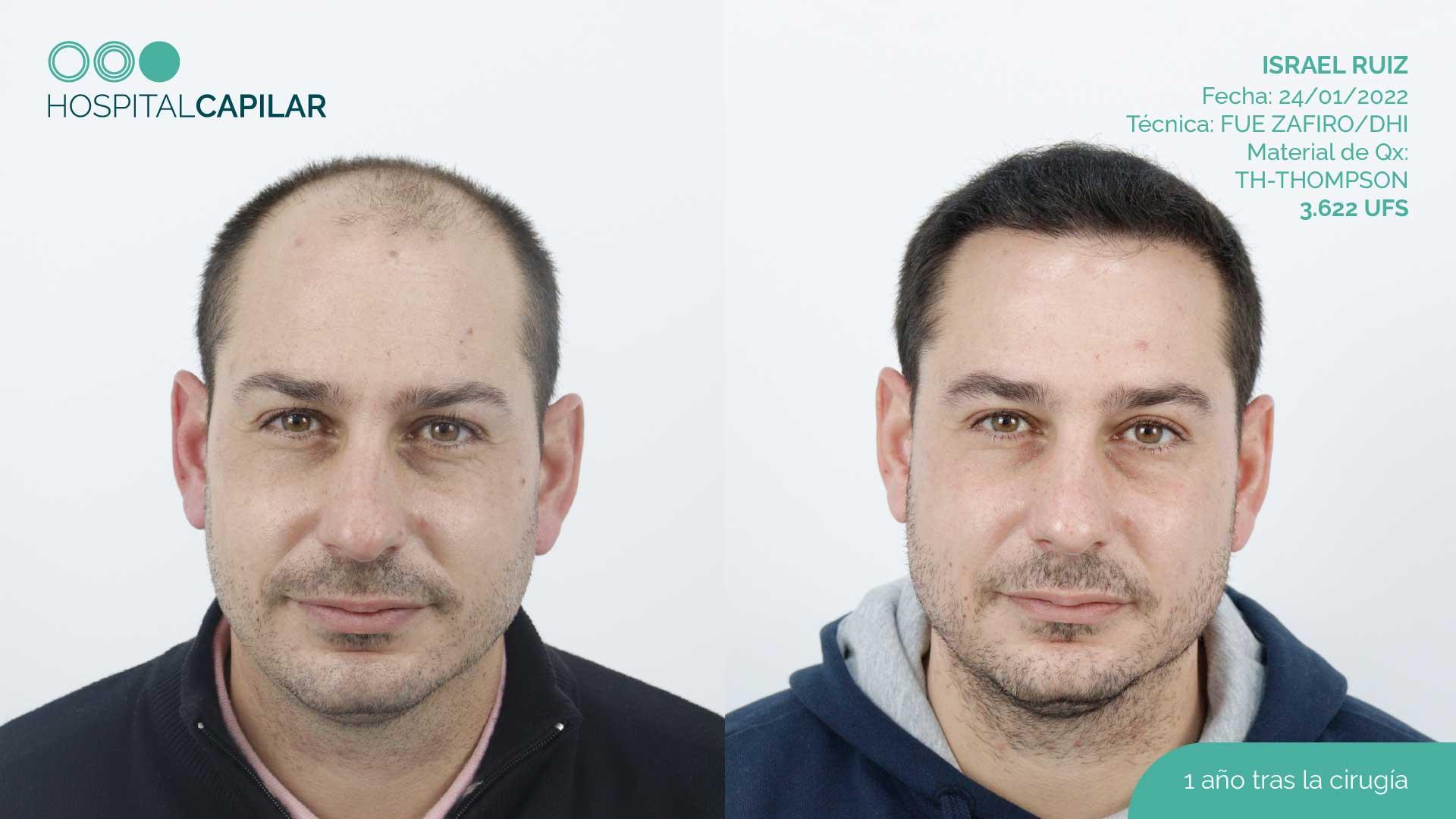 hospital capillar before and after hair transplant