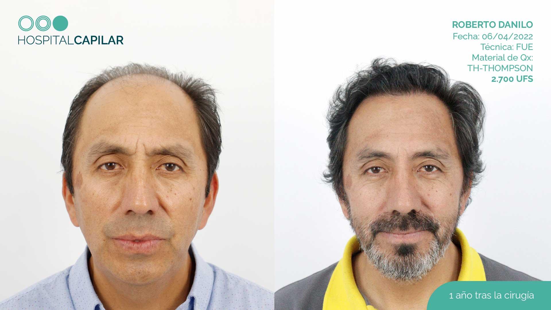 hospital capillar before and after hair transplant