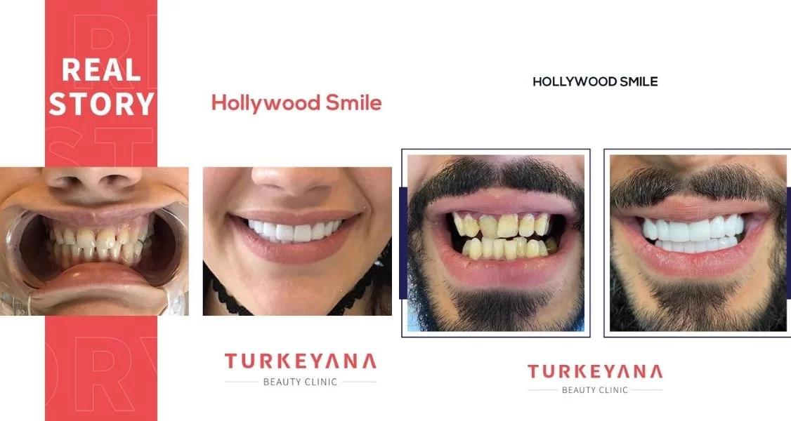 before-after-pictures-of-hollywood-smile-at-turkeyana-clinic