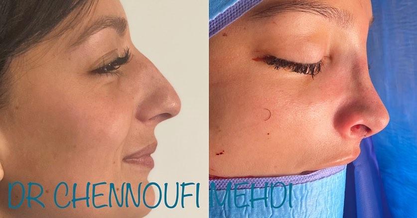 Rhinoplasy Mehdi Chennoufi 1