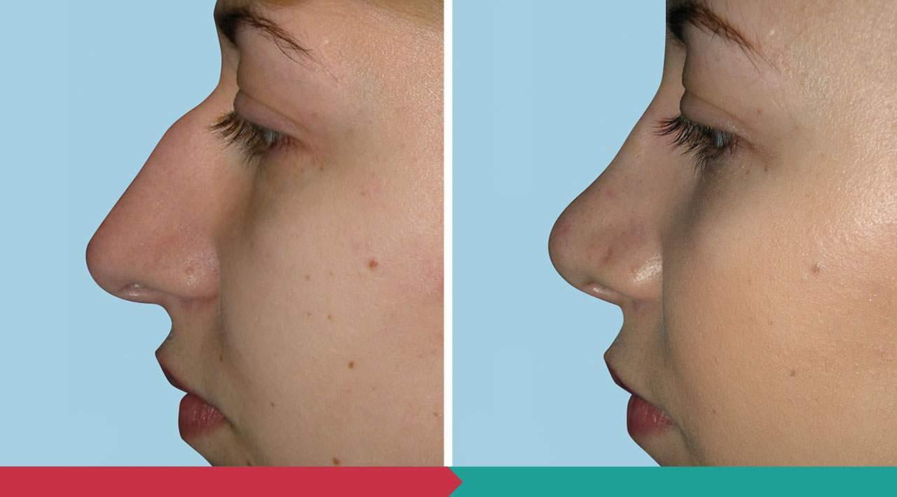 Rhinoplasty ABClinic Praha2