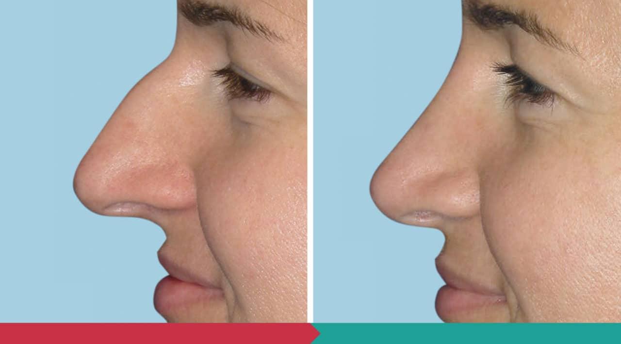 Rhinoplasty ABClinic Praha3