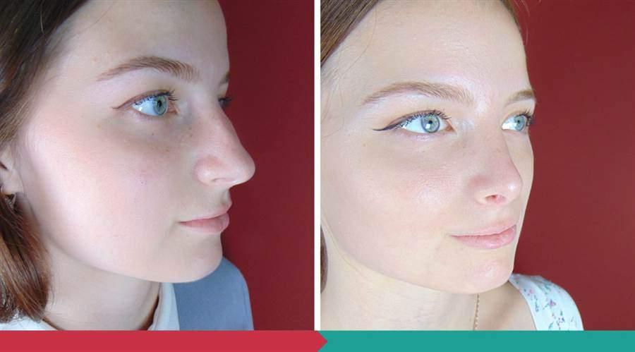 Rhinoplasty ABClinic Praha4