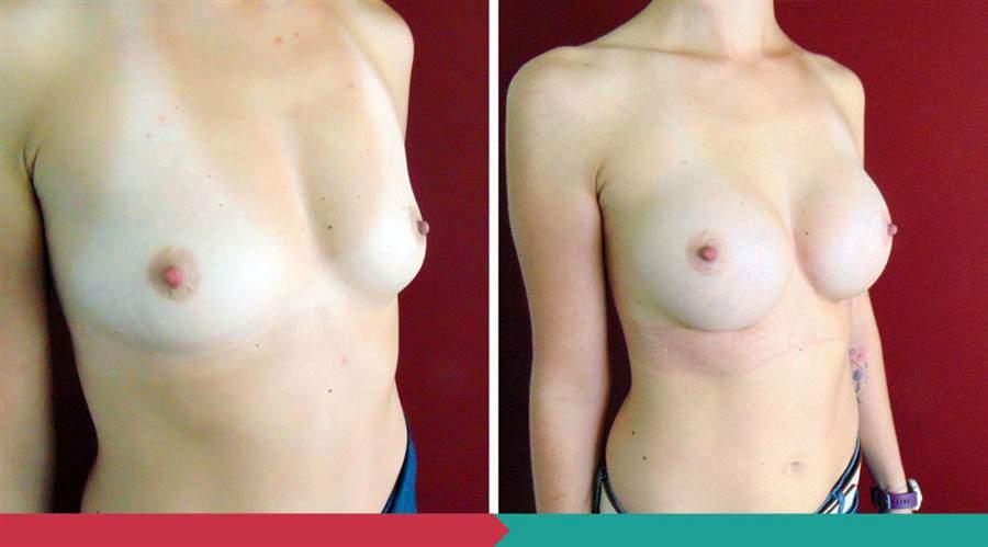 Breast Augmentation ABClinic Praha4
