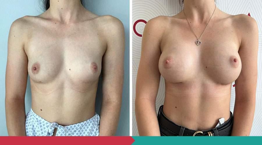 Breast Augmentation ABClinic Praha10