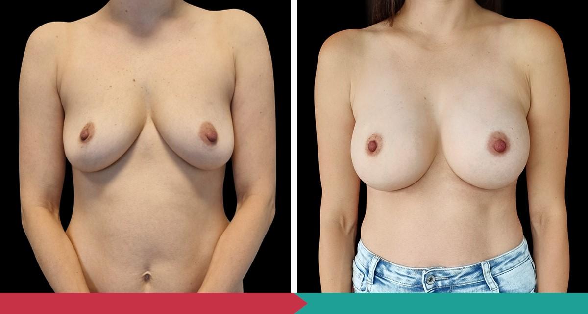 Breast Augmentation ABClinic Praha12