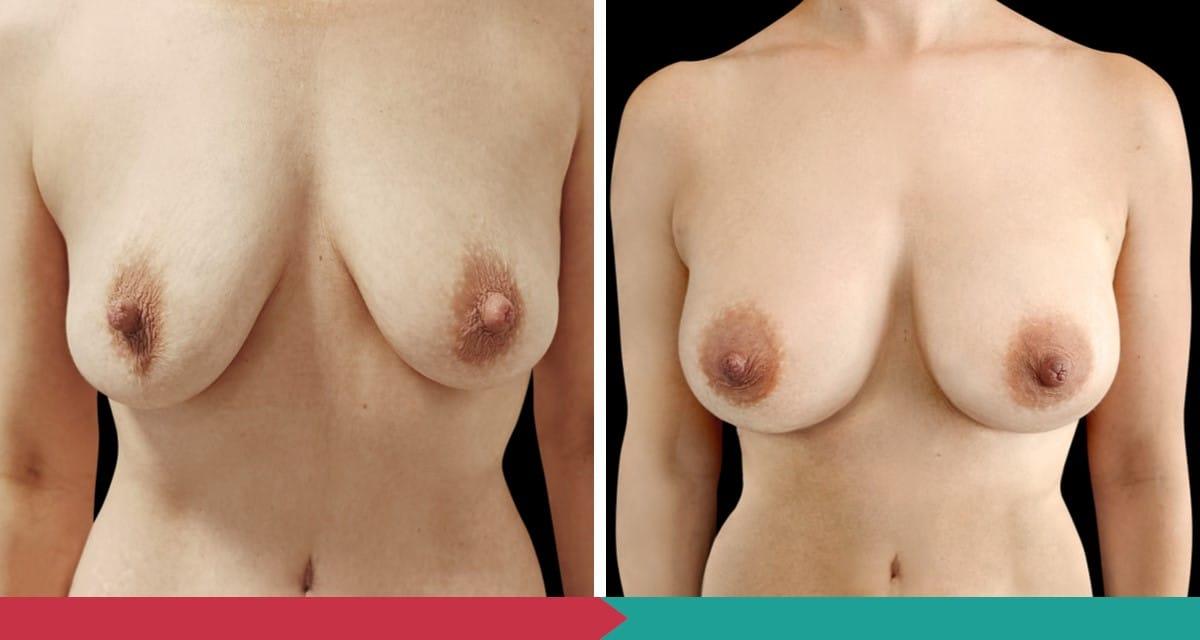 Breast Augmentation ABClinic Praha14