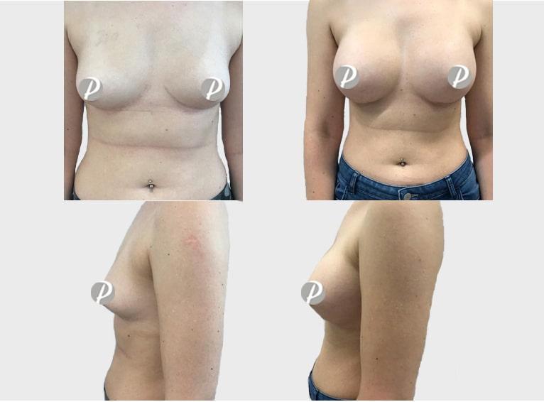 breastaugmentation-2-min