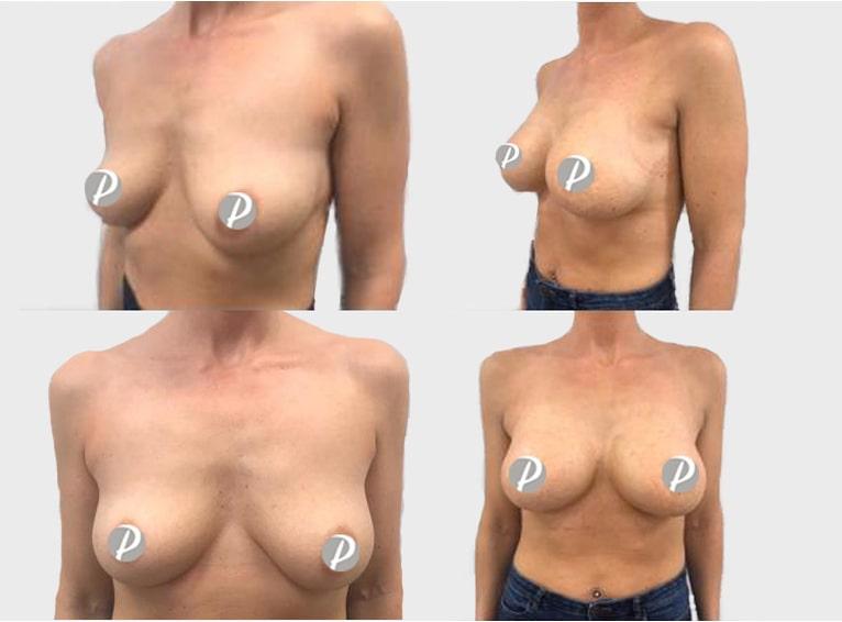 Breast Augmentation by Premier Clinic