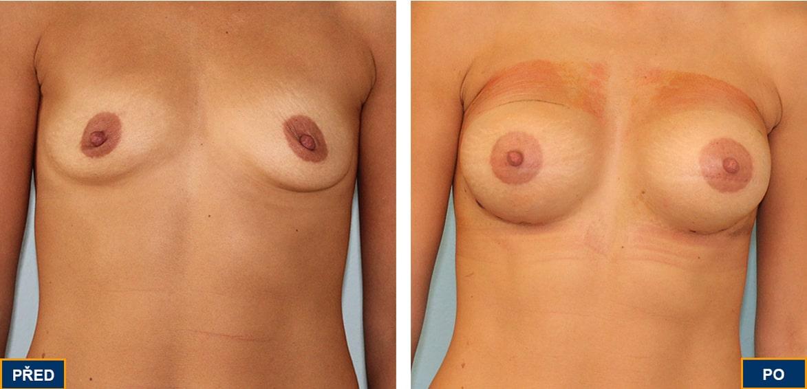 Breast Augmentation by Premier Clinic