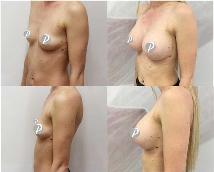 Breast Augmentation by Premier Clinic