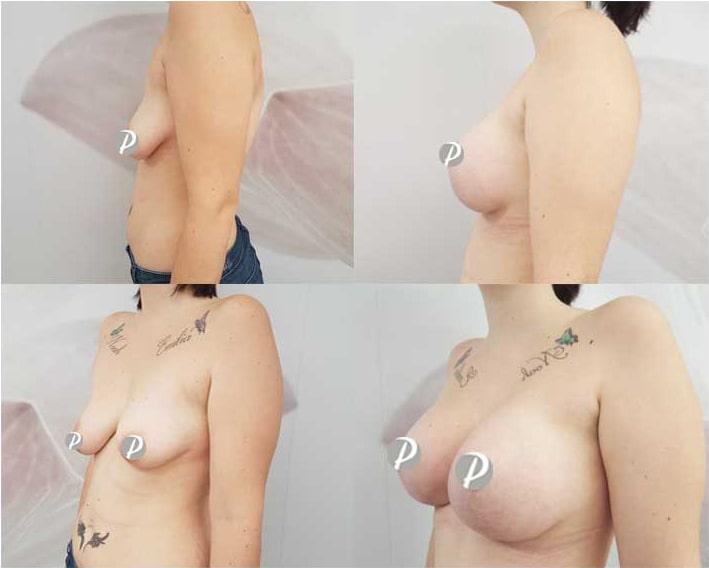 Breast Augmentation by Premier Clinic