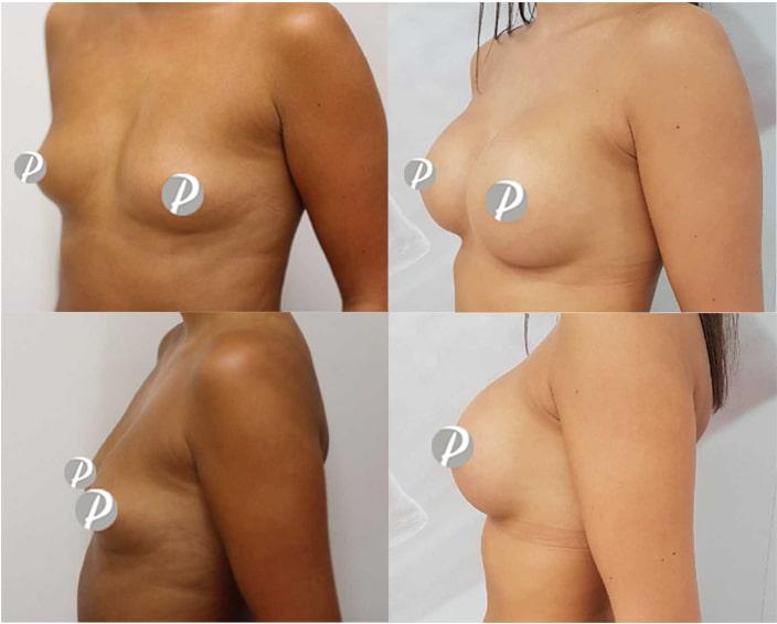Breast Augmentation by Premier Clinic