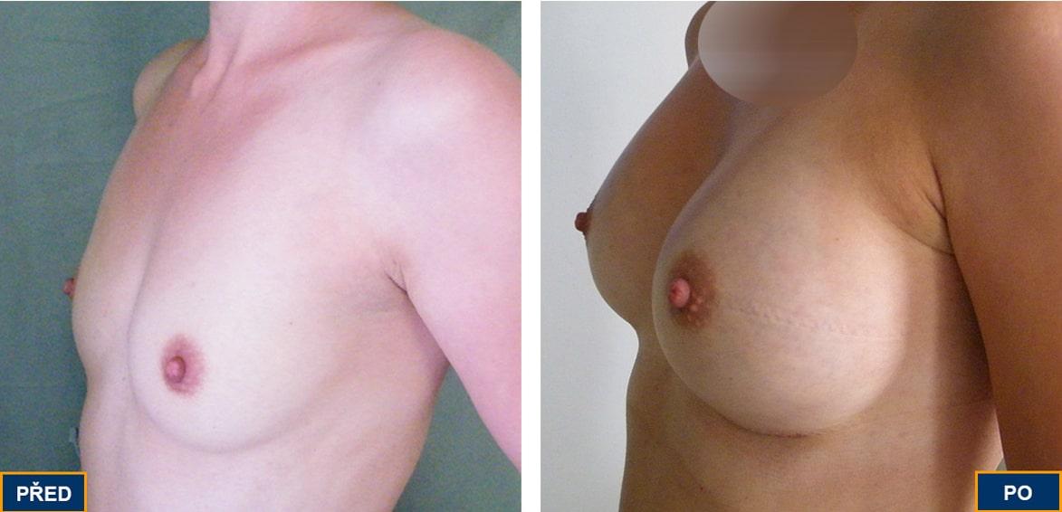 Breast Augmentation by Premier Clinic
