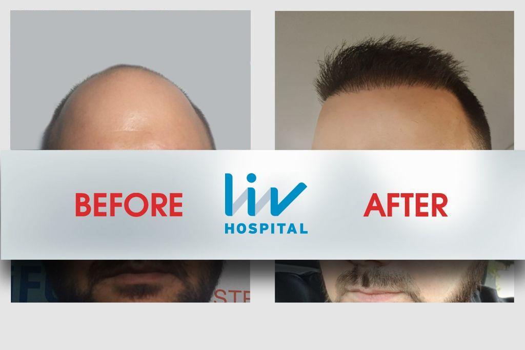 LIV Hospital before and after Hair transplant 1