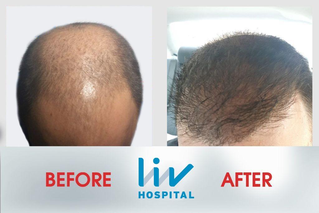 LIV Hospital before and after Hair transplant 2