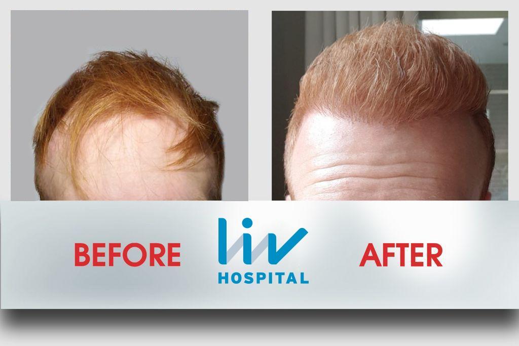 LIV Hospital before and after Hair transplant 3